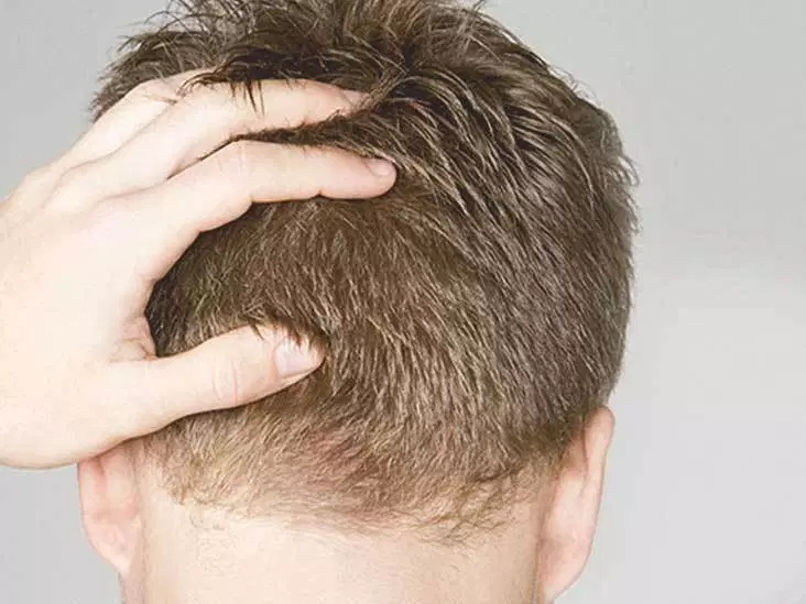 Hair Loss Treatment with Surgical Hair Restoration