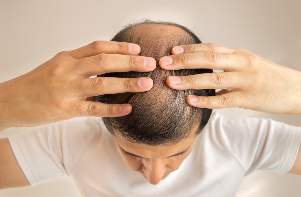 Hair Transplant Repair And Reversal: Facts Need to Know