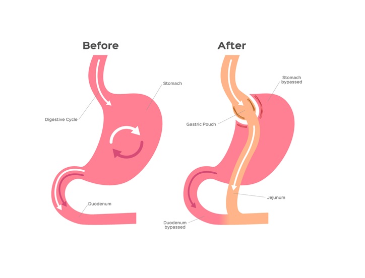 What to Expect After the Gastric Bypass Surgery