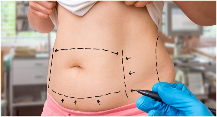 How Is Liposuction Different from Bariatric Surgery?
