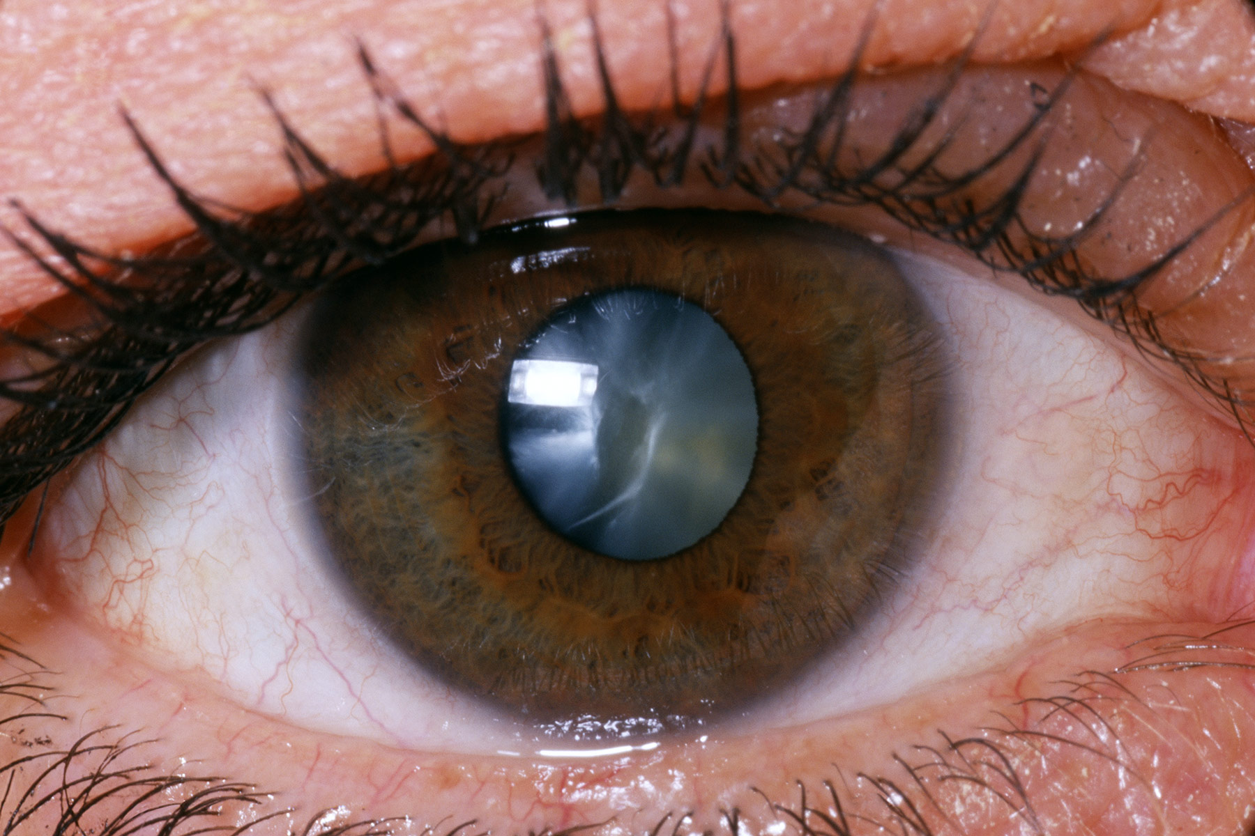 Should You Get Cataract Surgery Soon
