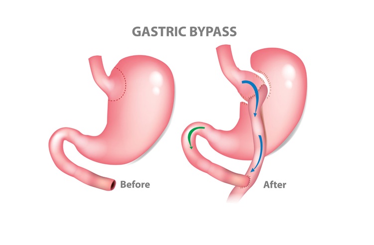 What Is Involved in The Procedure of Gastric Bypass