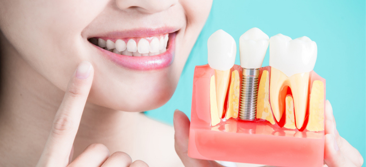 Know More About Dental Implants Marketing