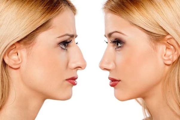 Closed Nose Job: A Less Invasive Approach to Rhinoplasty